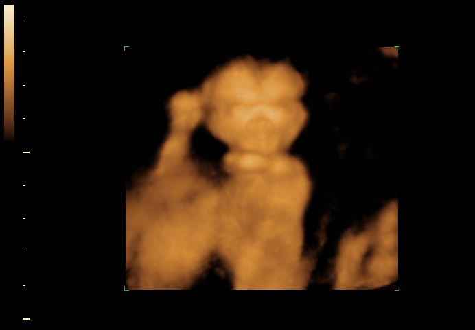 3D ultrasound image at 18 weeks